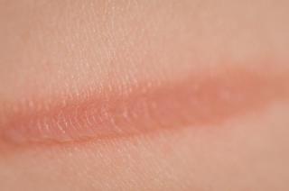 img_how_to_get_rid_of_burn_marks_on_the_skin_with_home_remedies_1630_orig